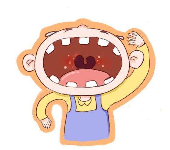 宝宝得疱疹性咽峡炎怎么办,疱疹性咽峡炎和手足口区别