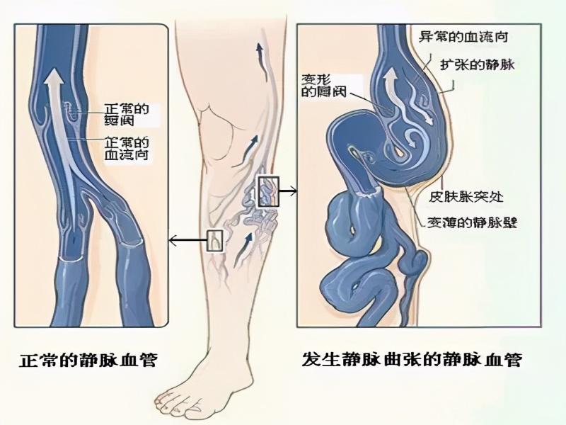 大腿上出现蚯蚓似的血管怎么回事,小腿血管像蚯蚓一样怎么治