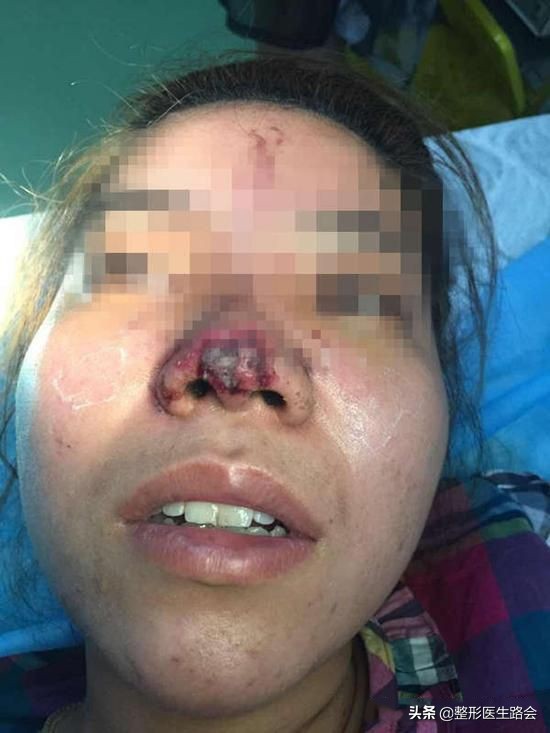 玻尿酸注射隆鼻可以热敷吗,玻尿酸注射鼻子有什么危害