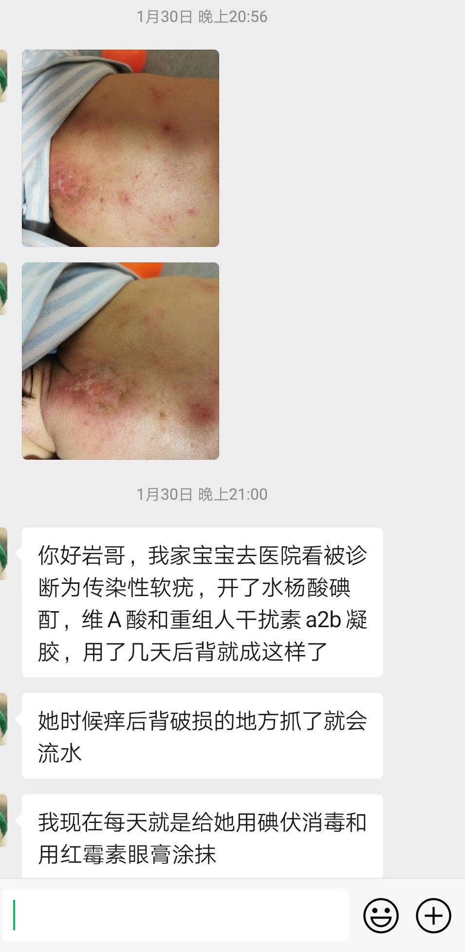 传染性软疣儿童怎么治可以断根,儿童脸上长了传染性软疣怎么办