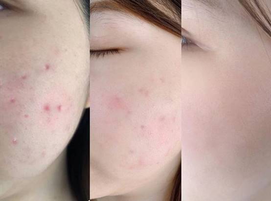 女生闭口痘痘怎么处理好得快,女生脸上有闭口痘痘怎么解决