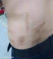 地塞米松新用途：轻松搞定医用胶粘剂相关性皮炎