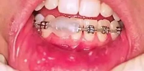 补牙戴牙套后注意事项,戴牙套吃东西要注意什么