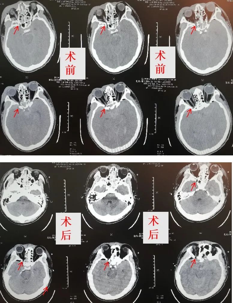 车祸眼部神经受损失明可以修复吗,车祸视神经压迫失明的恢复几率