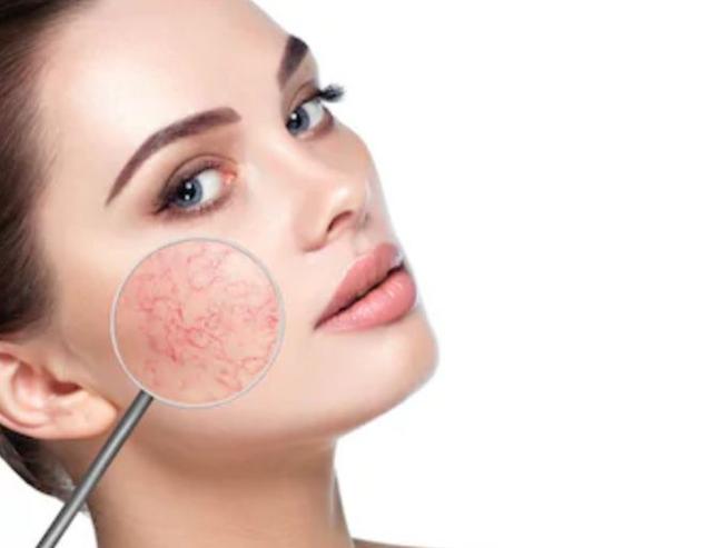 脸上出现蜘蛛状的血丝很疼,老年人脸上出现细血丝怎么回事