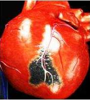 冠心病突发周围人如何急救,有冠心病的人平常表现