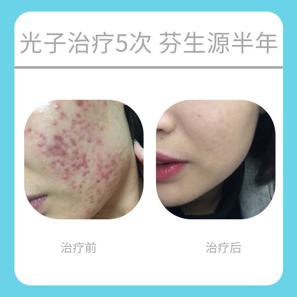 敏感性皮肤怎么修复角质层,过敏性皮肤怎样修复皮肤屏障