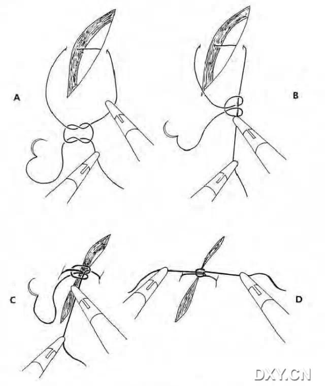 腹腔镜下切割缝合器使用视频,腹腔镜下缝合教程