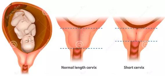 预防早产的特殊类型孕酮,孕酮预防早产机制