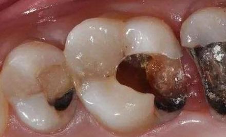 七类牙医,为什么医生不建议拔7号牙齿