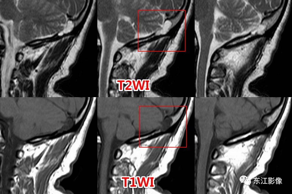 头颅mri扫描影像哪里找,头颅影像mra详细解说