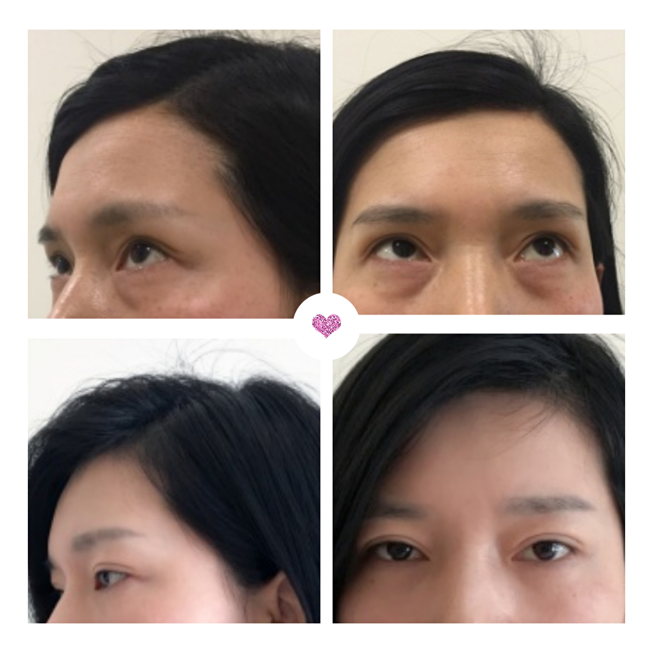 鱼尾纹眼袋怎么去除最有效,去除眼袋鱼尾纹最快最好的方法