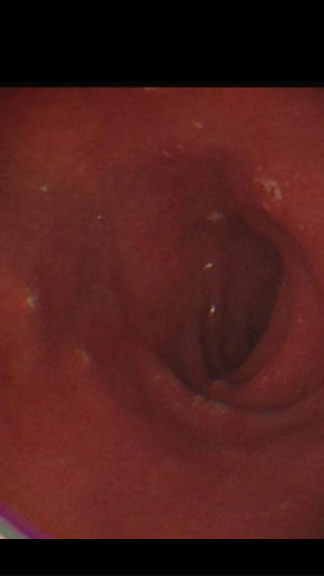 急性胃炎的症状及治疗方法,急性胃炎分类