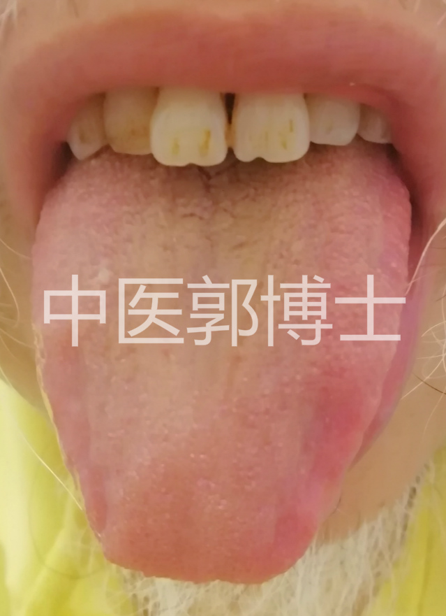 手指肿的已经戴不上戒指了,手指肿胀不能弯曲用什么药