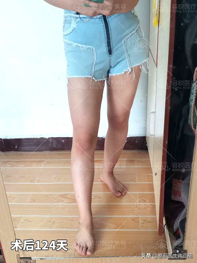 腿细腿部吸脂,大腿吸脂立马变细吗