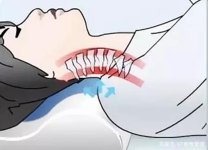 睡醒后脖子僵硬酸痛怎么缓解,起床后肩膀脖子酸痛如何缓解