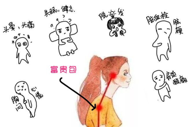 什么是“富贵包”?学会这几招,完美摆平颈后大包!