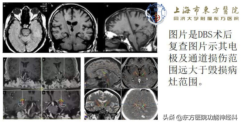 dbs手术与细胞手术,细胞刀和dbs手术的区别
