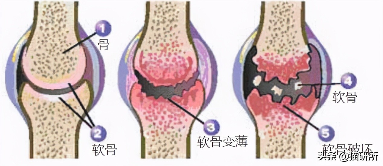软骨素治膝盖痛,软骨素对膝盖疼痛有效果吗