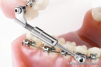 矫正牙齿不拔牙出现龅牙怎么办,40岁矫正牙齿拔牙不拔牙有区别吗
