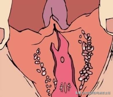 假性尖锐湿疣怎么根除,假性尖锐性湿疣可以不用治疗