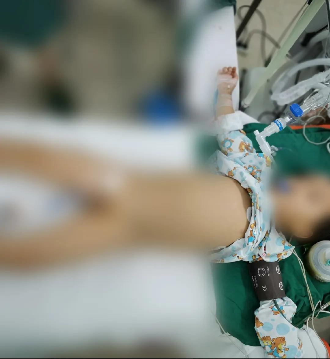 儿童小肠切除后遗症,儿童小肠切除术多久能恢复正常