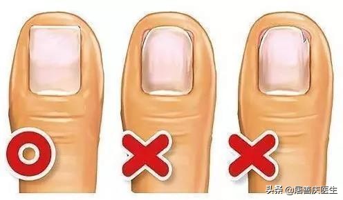 改掉啃手的习惯,拔肉刺引起甲沟炎