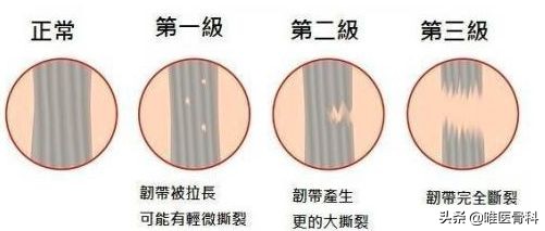 膝关节内侧副韧带损伤的诊疗进展,膝关节内侧副韧带损伤的正确叙述