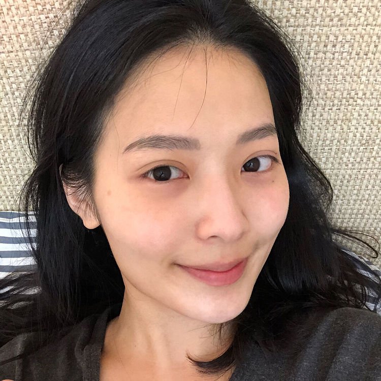 怎么快速消除毛囊炎,脸上老是长白头粉刺是不是毛囊炎