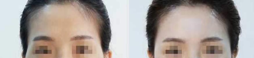 自体脂肪面部填充，让你的脂肪“动起来”