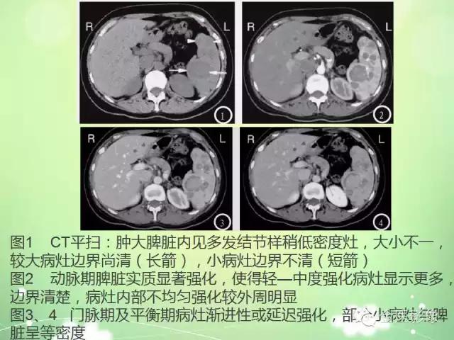 脾血管瘤中医辨证,脾血管瘤超声表现