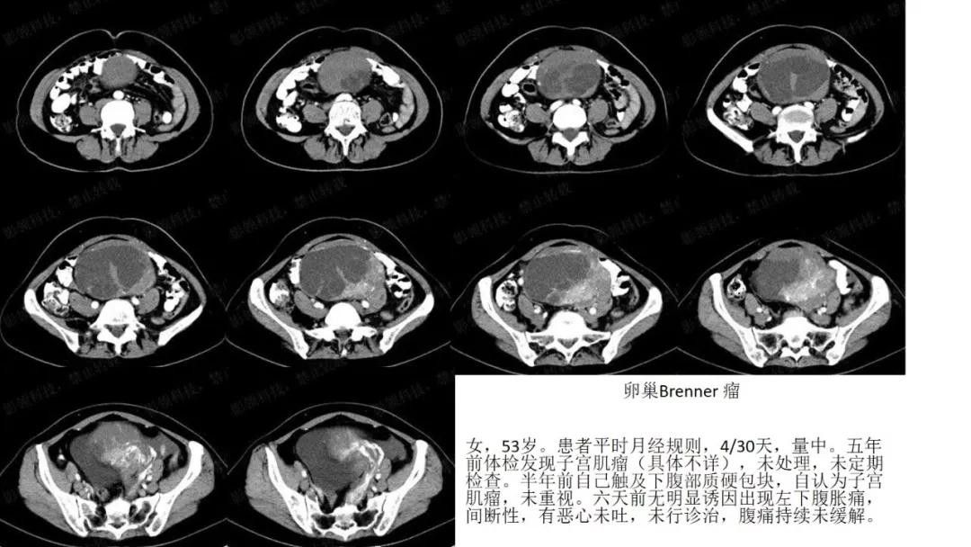 卵巢原发肿瘤的分析思路