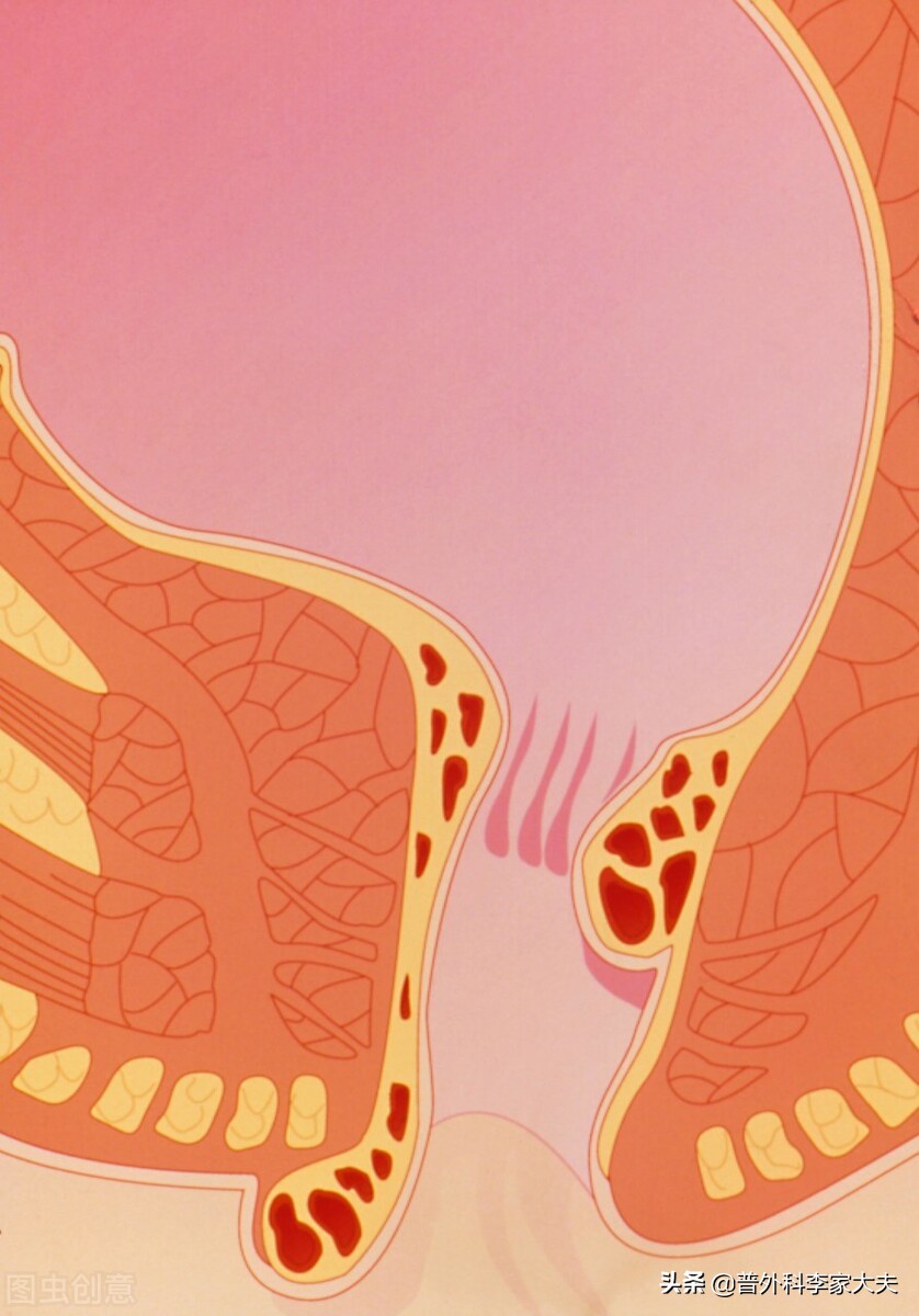 痔疮手术后一个月复发又长出外痔,为什么痔疮做了手术还便血