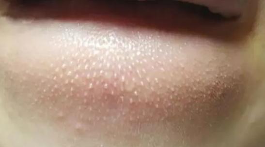 脸上粉刺留下硬块怎么去除,脸上一粒粒的粉刺怎么消除