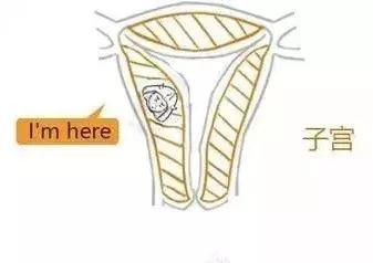 漫画详解子宫肌瘤是个啥？