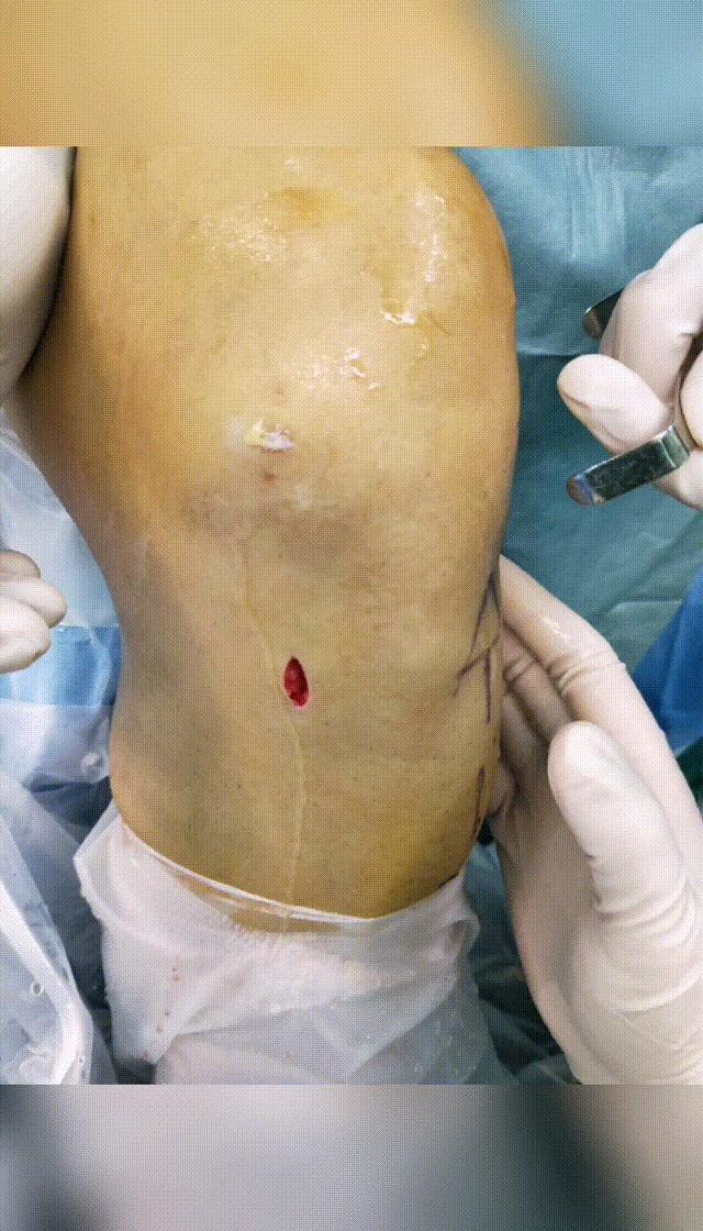 前交叉韧带断裂手术费用大概多少,前交叉韧带断裂重建手术最佳时间