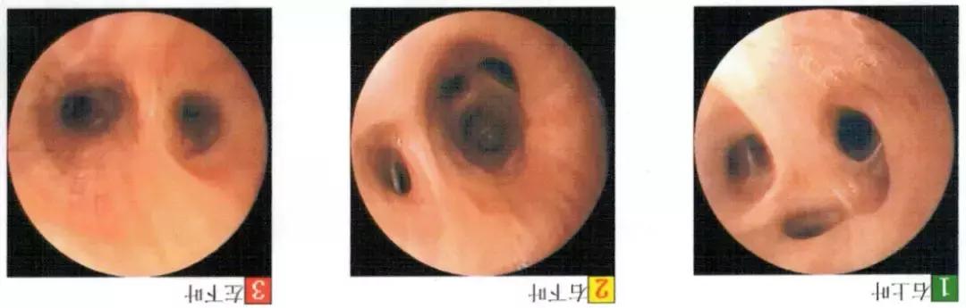 PCCM直播丨中年装修工人双肺多发空洞，奴卡菌＋曲霉菌如何治疗？