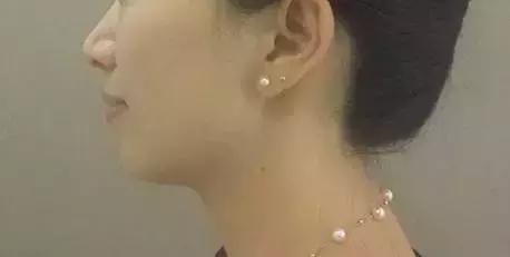 明星注射玻尿酸案例,注射玻尿酸变美