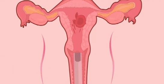 药物流产历经两周后仍有残留，清宫还是不清宫？