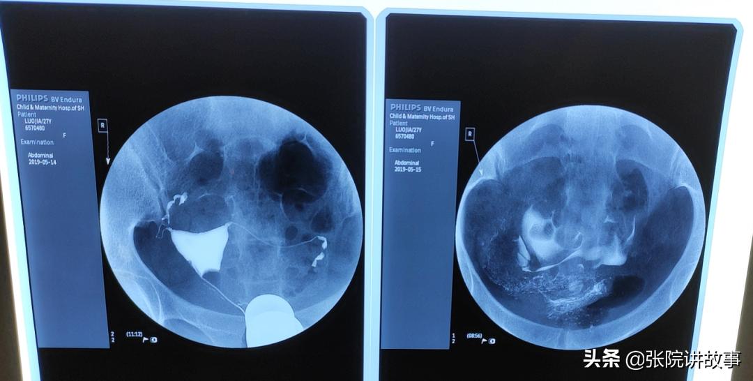 「张院讲故事」一直“通畅”的输卵管，为啥突然就功能异常了？