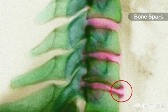 治疗颈椎病眩晕的药物,颈椎病疼痛麻严重吗怎么治疗