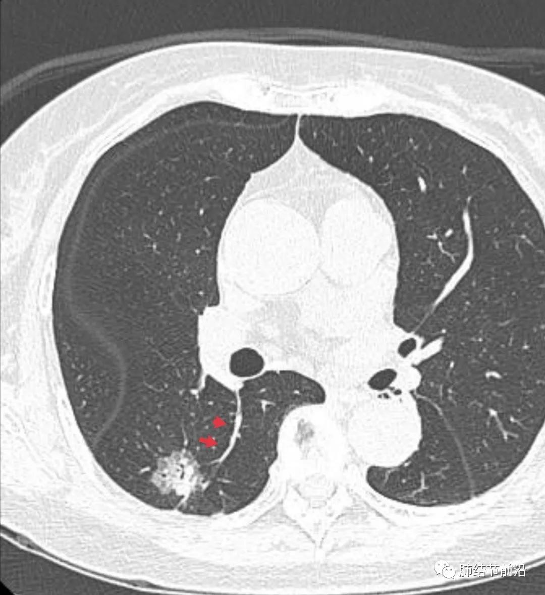 肺部ct肺结节读片教学视频,肺结节读片的专业术语