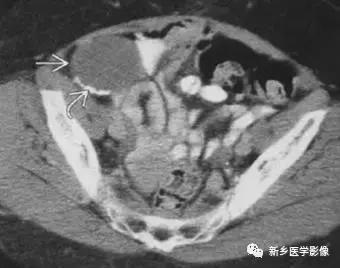 腹部平片能看到结石吗,腹部高密度结节影是什么