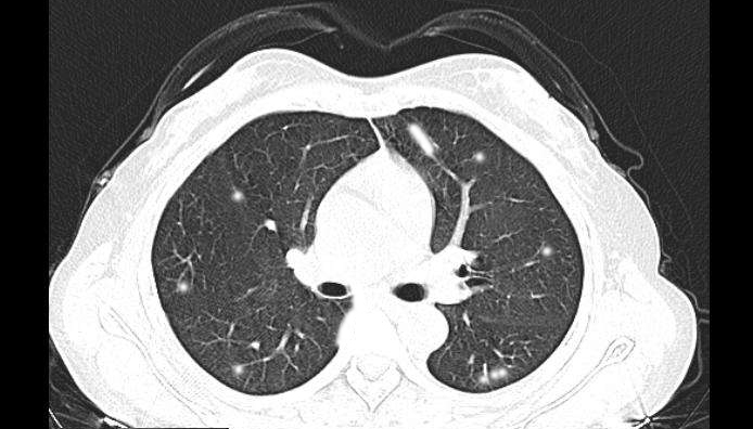 郑州两女子检查肺部,喷84消毒液多久得肺泡炎