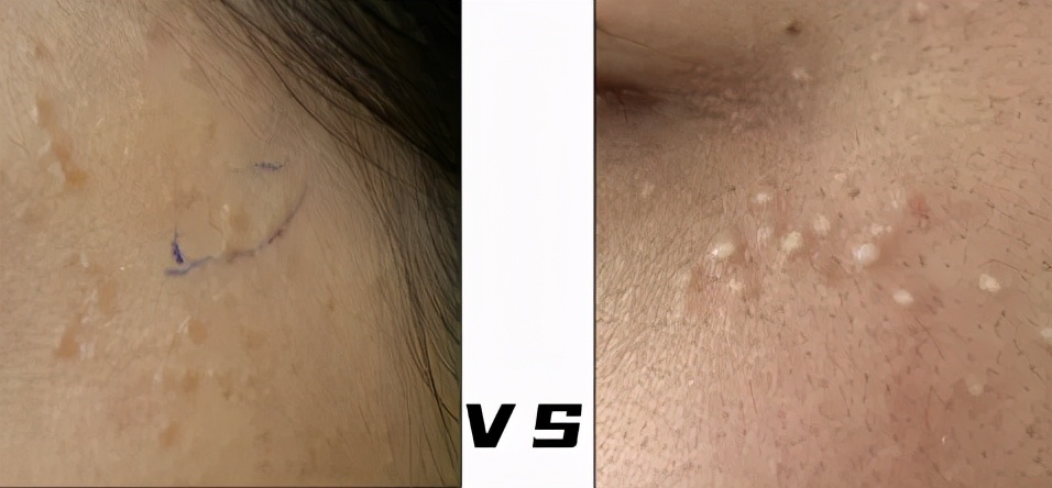 你以为的脂肪粒其实是肿瘤,脂肪粒会转变成癌吗