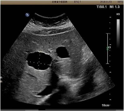 肝囊肿长水泡是什么原因,80岁老人肝囊肿肺水泡