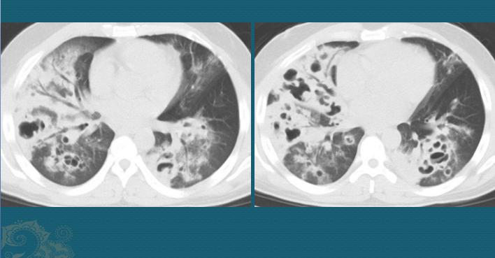 流感合并细菌感染好治疗吗,流感病毒肺炎怎么治疗
