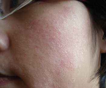 皮肤干像蛇皮怎么办,皮肤干的皱起来了怎么办