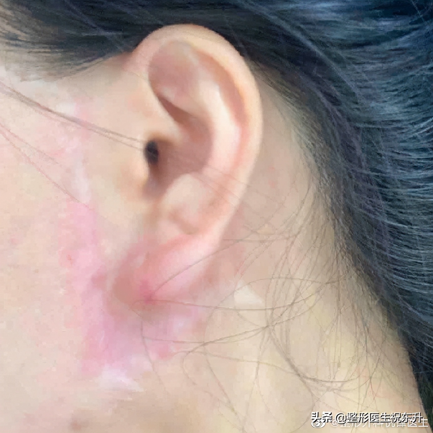 拉皮有后遗症吗会不会越老越快,50岁拉皮手术有生命危险吗