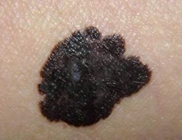 你身上有色素痣吗,你身上的痣有什么含义图片